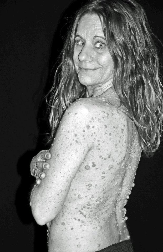 PICS BY LIBBY HUFFER / CATERS NEWS - (PICTURED: Libby took part in a daring photoshoot where she showed off her skin thanks to her daughter Lindsey, who gave her the courage not hide behind her condition any more) - Meet the bumpy lady whose shocking condition leaves woman with nearly 6,000 large tumours all over her entire body. Libby Huffer, from Fort Wayne in Indiana, USA, lived a happy, normal life until her teenage years when hundreds of bumps developed above her skin. At the age of five, she was diagnosed with Neurofibromatosis Type 1, NF-1, Libbys is one of the most severe forms of the condition that causes stone-like bumps to grow at the nerve endings. After her first outbreak of the non-cancerous tumours Libby was severely bullied with people darting away from her because they thought she was contagious and even called her Lizard-Breath. The cruel comments were so bad that she had to change her name from Elizabeth to Libby, because it was such a painful reminder her of the victimisation she faced growing up. While carrying her daughter, Lindsey, in 1993, her condition worsened when hormones released during pregnancy made her tumours multiply into the thousands. Now the mum has more than 5,500 tumours from her forehead to her feet and suffers daily chronic pain, even a hug can hurt her. - SEE CATERS COPY