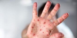 Mjekët paralajmërojnë epidemi të re të fruthit