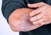 ‘Psoriaza’ prek mijëra qytetarë në Maqedoni: Sëmundja që dëmton jo vetëm lëkurën, por edhe shëndetin mendor!