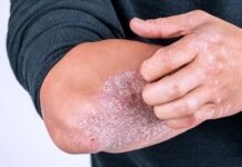 ‘Psoriaza’ prek mijëra qytetarë në Maqedoni: Sëmundja që dëmton jo vetëm lëkurën, por edhe shëndetin mendor!