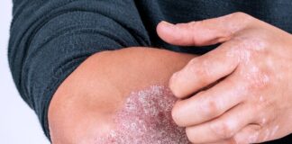 ‘Psoriaza’ prek mijëra qytetarë në Maqedoni: Sëmundja që dëmton jo vetëm lëkurën, por edhe shëndetin mendor!